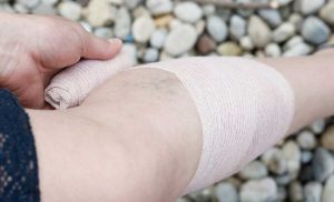 Read more about the article 5 Ways to Prevent Deep Vein Thrombosis While Traveling